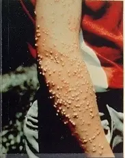 Impact of Fire Ants (Environmental quality) in Middle Tennessee